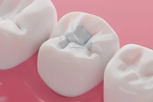 Coventry White Fillings Dentist Private Offer Announced by Light Lane Dental Practice